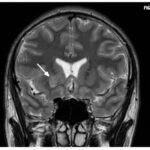 When Should Brain Imaging be Performed? A Case Report of Caudate Nucleus Infarct