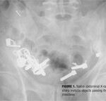 Swallowing Foreign Bodies as an Example of Impulse Control Disorder in a Patient with Intellectual Disabilities: A Case Report