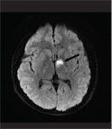 Visual Hallucinations Following a Left-sided Unilateral Tuberothalamic  Artery Infarction