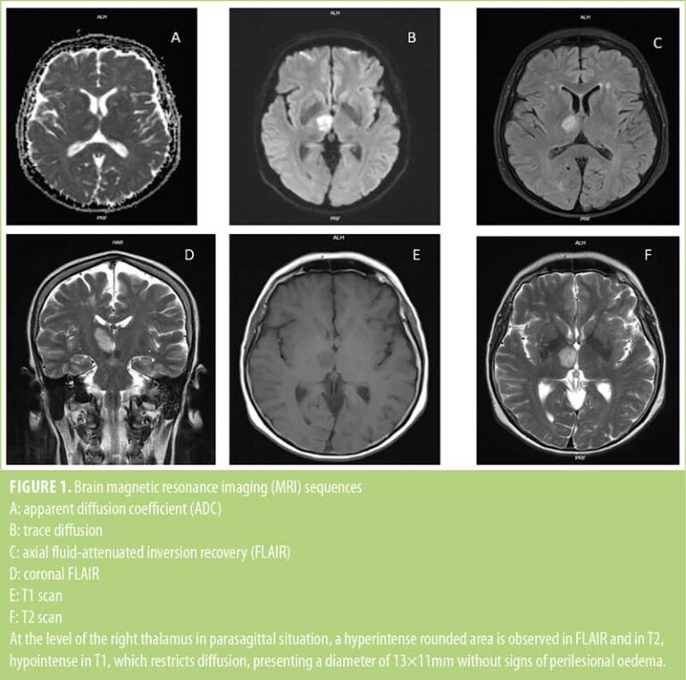 Acute Thalamic Ischemic Stroke in an Older Patient Newly Vaccinated ...
