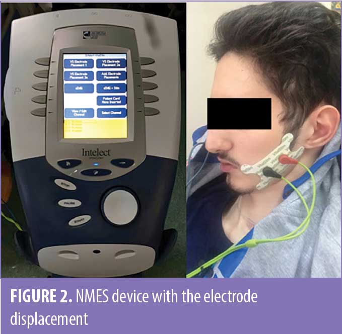 Intelect Neuromuscular Electrical Stimulation NMES Units