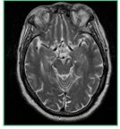 A Probable Case of Peduncular Hallucinosis Secondary to a Cerebral Peduncular Lesion Successfully Treated with an Atypical Antipsychotic